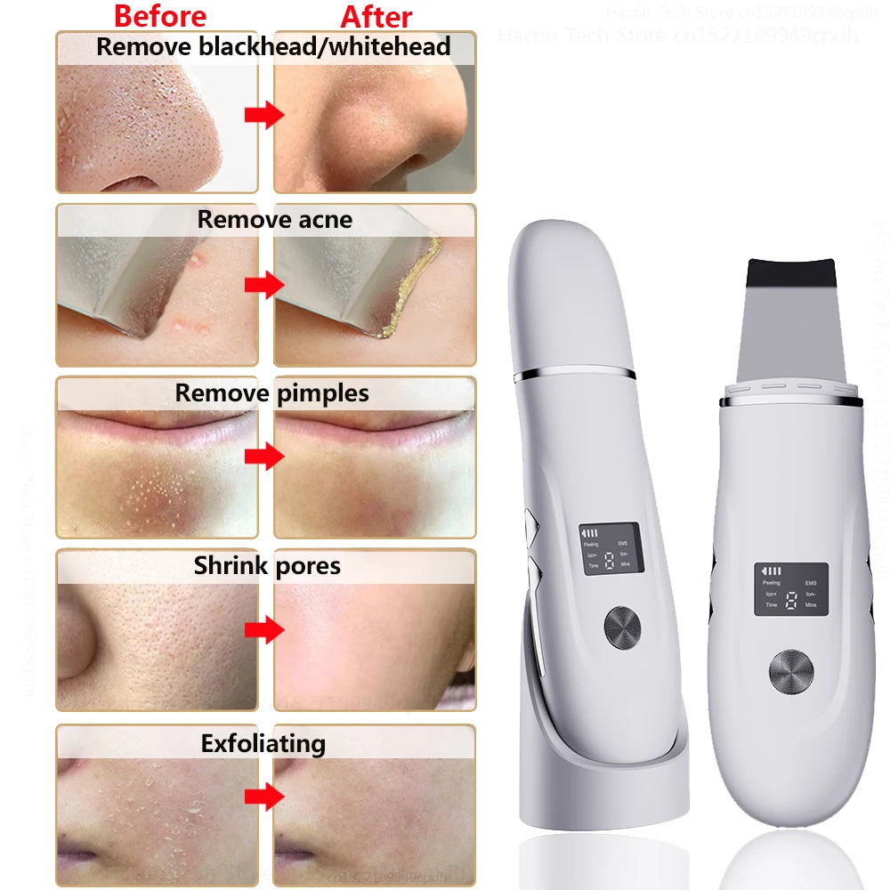 Ultrasonic Cleaner Peeling Remover Blackhead Facial Skin Scrubber Facial Shovel Deep Cleaning Face Lifting Removal Pore Acne EMS